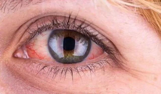 Yaz serinliği göz sağlığınızı tehdit etmesin: 6 koruyucu öneri